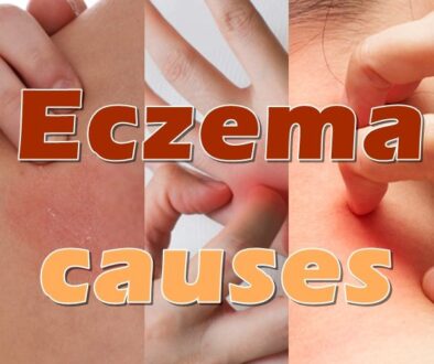 Eczema always consists of a rash, which could show up on any portion of the body.