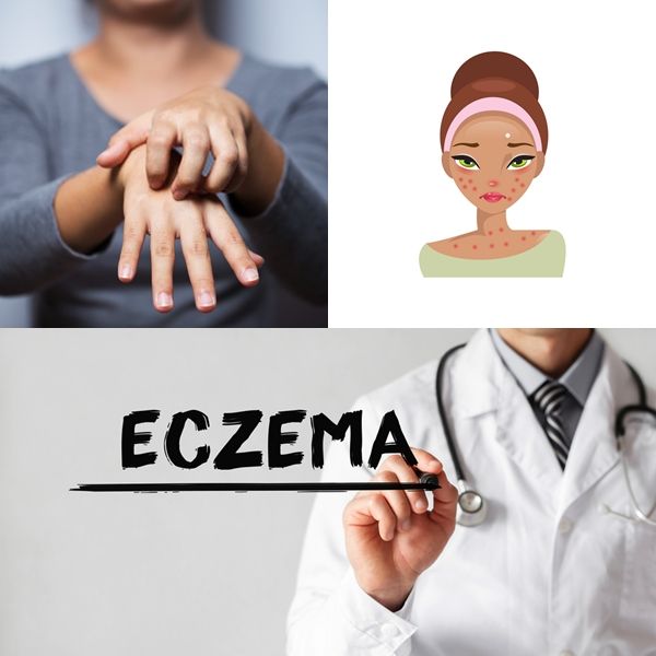 Eczema could be a vicious circle. More often than not, eczema rashes, also, have blisters. If these blisters grow sufficiently big, they could become infectious.