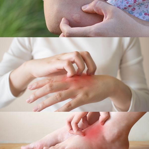It’s a well-known fact that everybody with eczema is affected by constant itching. There is no eczema without itching.